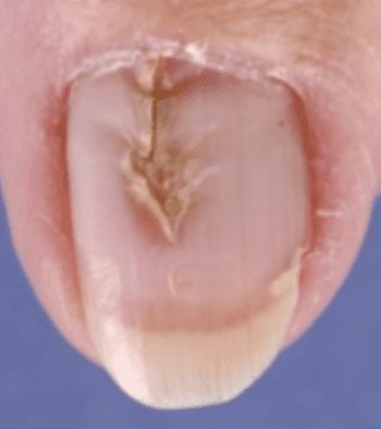 Solenonychia, or Heller's Median Nail Dystrophy